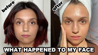 I got BOTOX in my jaw and THIS happened  3 month TMJ treatment update [upl. by Ydnamron444]