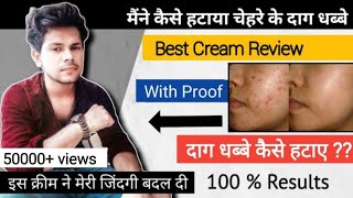 Chehre Ke Daag Dhabbe Hatane Ke Liye Best Cream Review Chehre Ke Daag Dhabbe Kam Kaise Kare हिंदी [upl. by Butterworth]