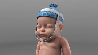 Diamedica Baby CPAP [upl. by Heins840]