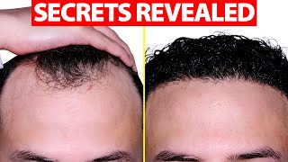 How to Fix Your Receding Hairline [upl. by Iatnwahs586]