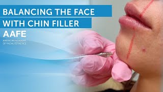 Chin Filler Changes Your Face Treatment  Before and After [upl. by Nyla]