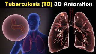 What Happens in Tuberculosis TB  3D Animation  Types Causes Symptoms Treatment UrduHindi [upl. by Lattie]