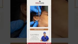 Mole Removal by Radiofrequency ablation [upl. by Aihsik]