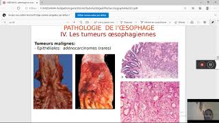 pathologie du tube digestif Pr MEDJAMIA [upl. by Urien]