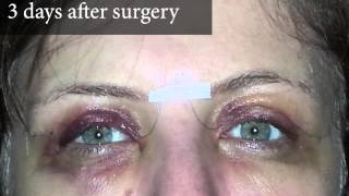 Upper Eyelid Surgery  After Photos 3 Days Post Surgery  8 West Clinic in Vancouver BC [upl. by Eirrac]