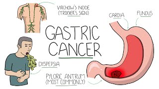 Gastric Cancer  An Overview for Students and Junior Doctors Including Troisiers Sign [upl. by Rilda]