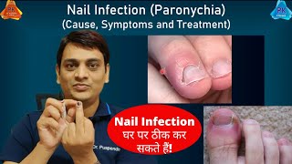 Nail Infection Paronychia  Cause amp Treatment  नाखून संक्रमण का इलाज कैसे करें Dr Puspendra [upl. by Moulton]