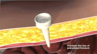 Full Fascial Port Site Closure with the Carter Thomason CloseSure System [upl. by Tadd]