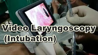 Video Laryngoscopy  Endotracheal Intubation  Laryngoscopy  General Anesthesia  Bougie Wire [upl. by Joao]