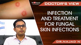 Infection and Treatment for Fungal Skin Infections  Dr Najad N  Health [upl. by Fredkin42]