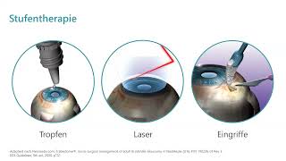 Endlich keine Augentropfen mehr Aktuelles von den VorderkammerImplantaten bei Glaukom [upl. by Blancha584]