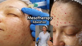 Mesotherapy for Face including around the Eyes injection technique using 13mm 30G needle [upl. by Lucic11]