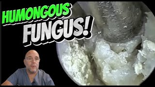 HUMONGOUS FUNGUS 339 ear earwax earwaxremoval asmrearwax satisfying foryou fyp foryourpage [upl. by Maclaine]