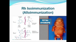 Rh Isoimmunization [upl. by Onahpets]