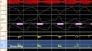 WatchPAT Manual Editing of Sleep Scoring [upl. by Nrubloc]