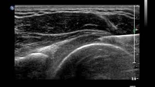 How to inject the Glenohumeral Joint Shoulder Joint under Ultrasound Guidance [upl. by Nuarb505]