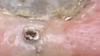 Blackheads • Nose Blackheads • Blackheads 2021 New • Blackheads On Nose • Blackheads Nose [upl. by Ewall210]