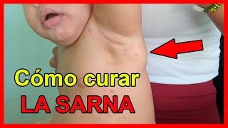 Brote de SARNA en Cuba 😖 Cómo tratar y CURAR la piel SIN MEDICINAS ✅ [upl. by Acker]