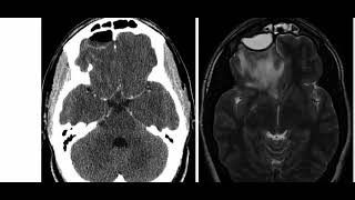 TOP 3 DIFFERENTIALS IN NEURORADIOLOGY [upl. by Platon511]