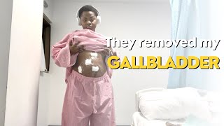 MY LAPAROSCOPIC GALLBLADDER REMOVAL SURGERY  RECOVERY [upl. by Eirovi]