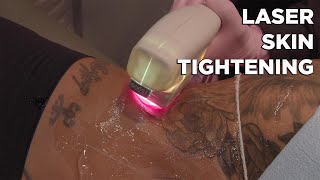 This laser tightens skin without surgery [upl. by Anitsuj47]