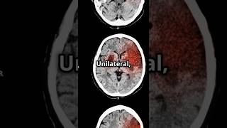 SturgeWeber Syndrome Mnemonic medicalstudent medicaleducation usmlepreparation DiagnosticLens [upl. by Keg]