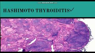 HASHIMOTOS Thyroiditis 5 Things YOU Need to Know 2024 [upl. by Annairba]