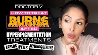 Doctor V  How To Treat Burns after Hyperpigmentation Treatments  Skin of Colour [upl. by Nickola]