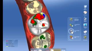 CEREC Software 42  Virtual Articulation [upl. by Abdella]