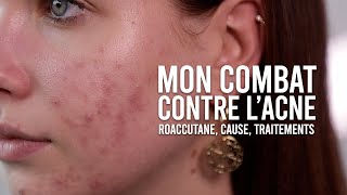 MON COMBAT CONTRE LACNÉ CAUSE TRAITEMENTS amp MON AVIS SUR ROACCUTANE [upl. by Macegan]