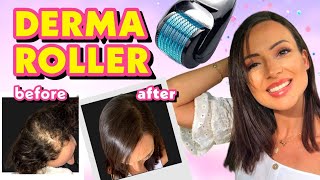 DIY TREATMENT DERMA ROLLER FOR HAIR LOSS  MIRACLE SECRET CURE [upl. by Block]