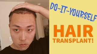 DoItYourself DIY Hair Transplant Possible [upl. by Edahs268]