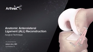 Anatomic Anterolateral Ligament ALL Reconstruction [upl. by Norreht]