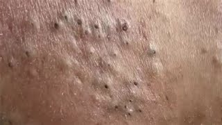 Removal of BLACKHEADS and WHITEHEADS  Acne Treatment [upl. by Naek]