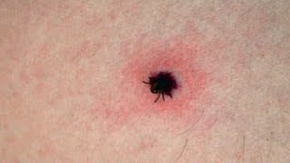 How Ticks Get On You amp Where They Lurk amp How To Prevent Ticks [upl. by Ellennaj]