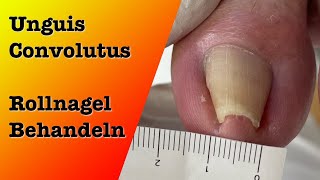 Unguis Convolututs Rollnagel Behandlung 1  podologinandrea [upl. by Koenraad]