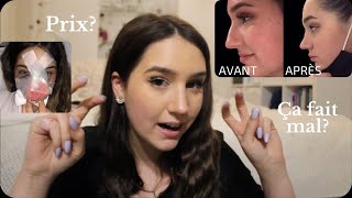 MA RHINOPLASTIE  Vlog Expérience Prix Conseils [upl. by Anairdna567]