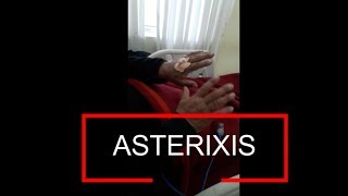 Asterixis  Flapping Tremor  Liver Flap [upl. by Marty268]