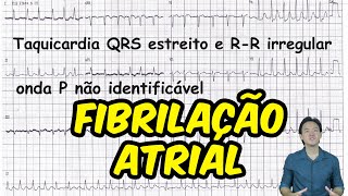 Eletrocardiograma  análise  Fibrilação atrial [upl. by Marcella857]