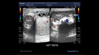 Ultrasound Video showing Epididymoorchitis Pyocele with septation Scrotal and Epididymal mass [upl. by Kendell]