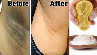 Baking Soda for Underarm Whitening  Dark Underarms Home Remedy [upl. by Ahsyas]