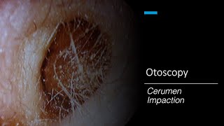 Cerumen Impaction Otoscopy [upl. by Paley78]