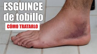 ESGUINCE o TORCEDURA de TOBILLO 🦶🏼 Tratamiento De Rotura De LIGAMENTOS De Tobillo ⭐ Dr EDSON SERRANO [upl. by Zicarelli519]