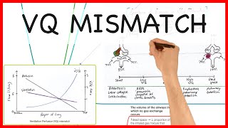 VENTILATION PERFUSION VQ MISMATCH PHYSIOLOGY SERIES [upl. by Sophronia]