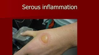 Serous Inflammation  Definition and Characteristics [upl. by Suiram]