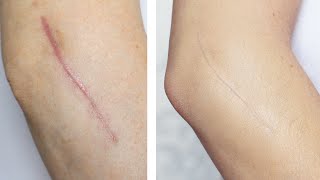 How To Cover  Conceal A Scar [upl. by Lolande]