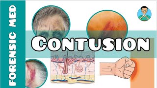 Contusion  What is a contusion injury  What causes of bruising  What are the types of bruises [upl. by Kendyl]