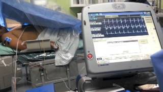 AICD defibrillation threshold test [upl. by Biancha]