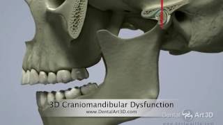 DentalArt3D 3D Craniomandibular Dysfunction [upl. by Pimbley]