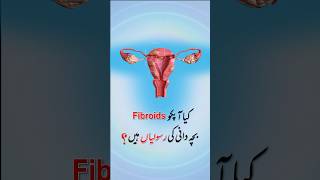 Uterine Fibroids Treatment Summarised fibroids [upl. by Kast]